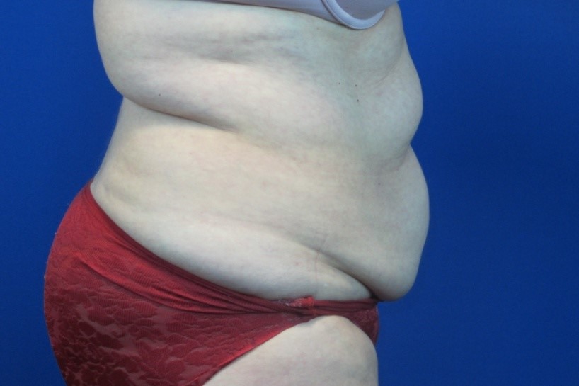 Before treatment: Sheboygan Tummy Tuck