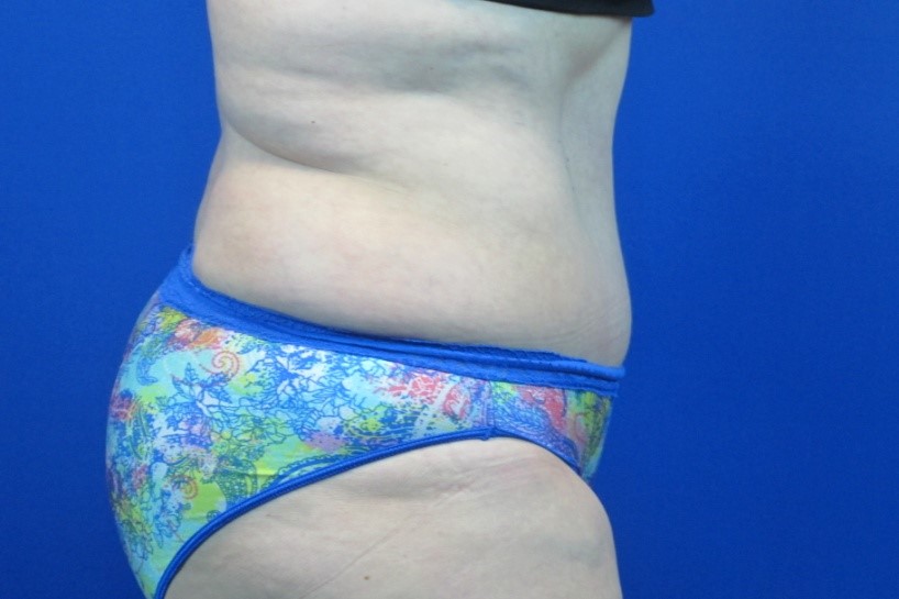 After treatment: Sheboygan Tummy Tuck