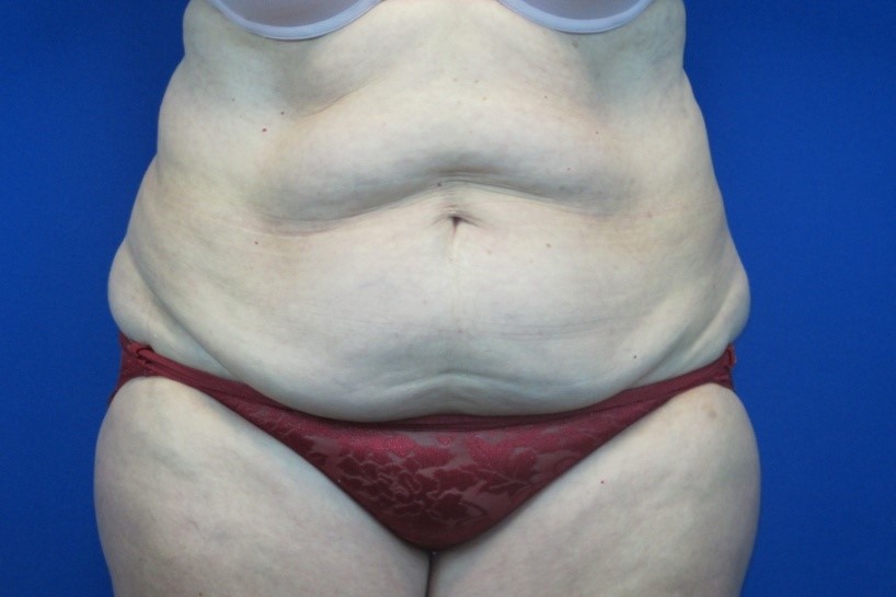 Before treatment: Mommy Makeover Muskego