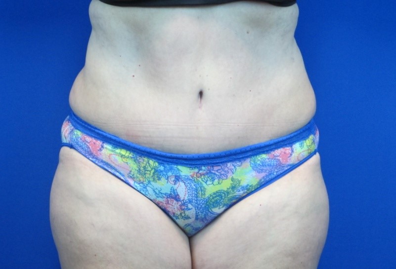 After treatment: Mommy Makeover Muskego