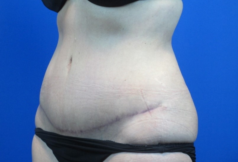 After treatment: Oak Creek Mommy Makeover