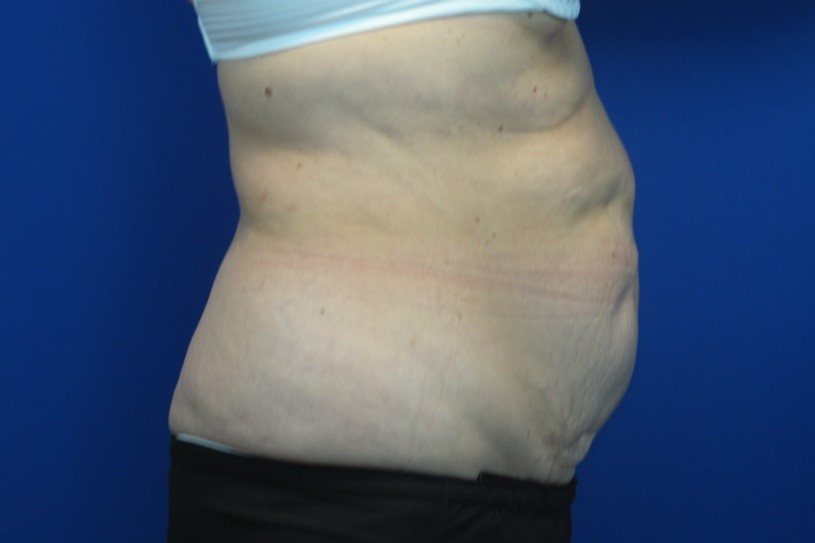 Before treatment: Wauwatosa Mommy Makeover