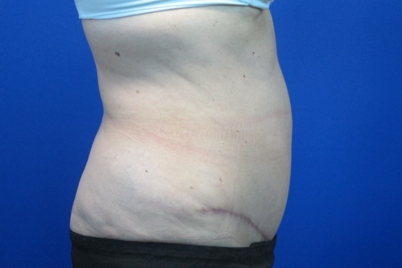 After treatment: Wauwatosa Mommy Makeover