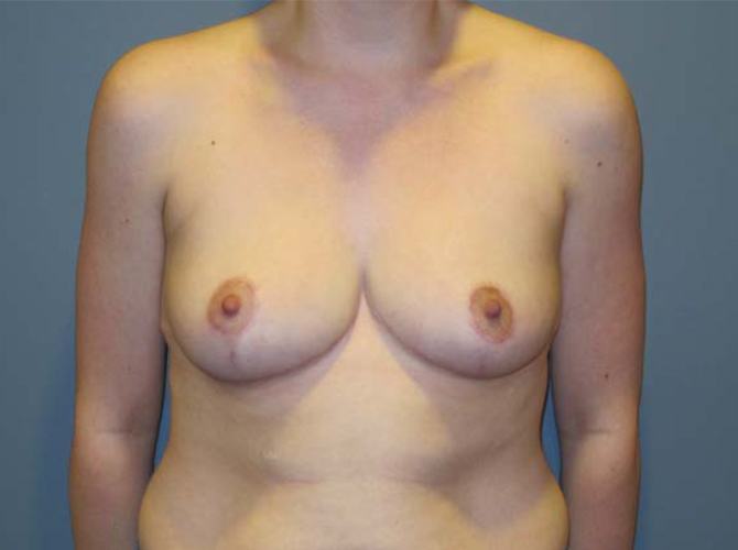 After treatment: Breast Reduction Surgery Waukesha Patient Transformation