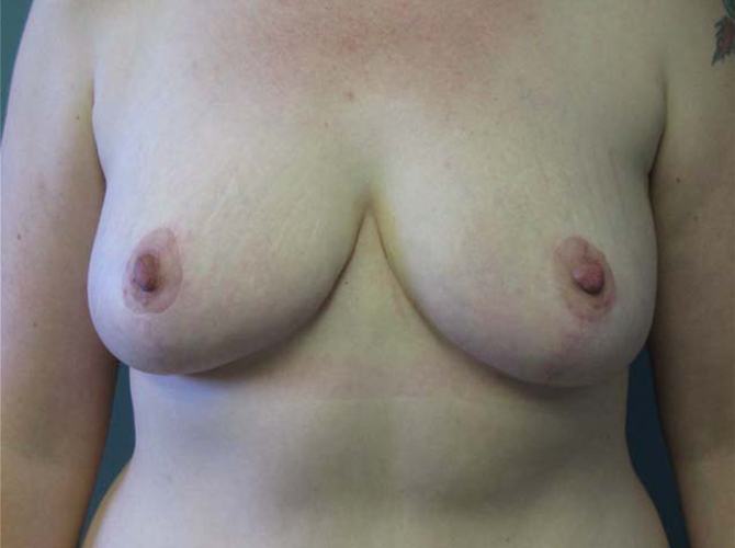 After treatment: Breast Reduction Milwaukee