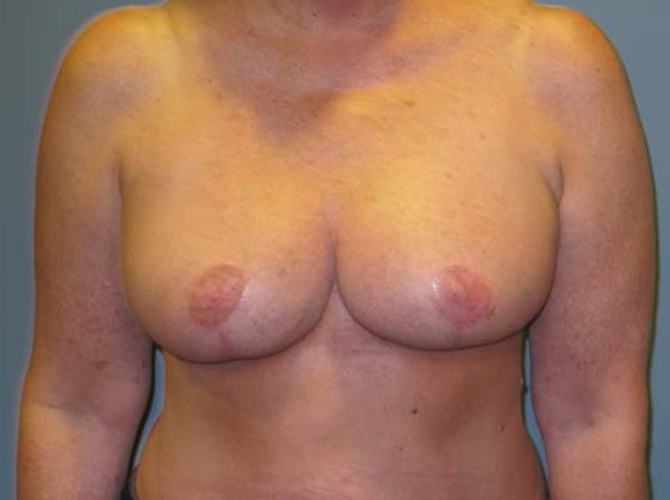 After treatment: Breast Augmentation Shorewood WI