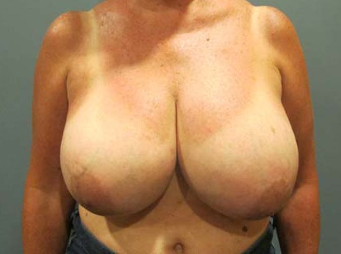 Before treatment: Breast Augmentation Shorewood WI