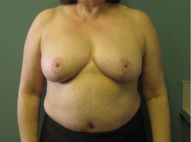 After treatment: Breast Augmentation Brookfield, WI Patient Transformation Photos