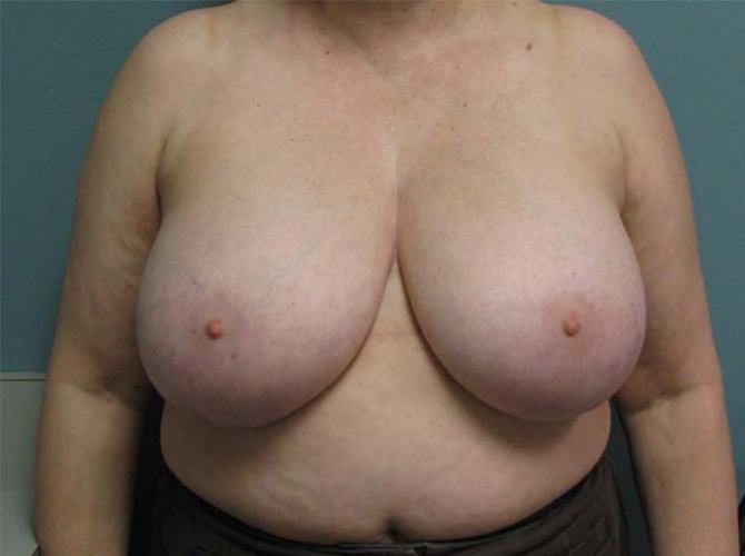 Before treatment: Breast Augmentation Brookfield, WI Patient Transformation Photos