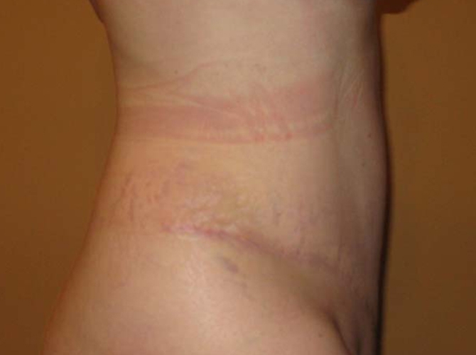 After treatment: Tummy Tuck and Liposuction Milwaukee, WI Patient's Before and After Photos