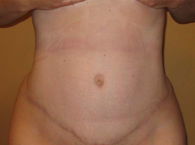 After treatment: Wisconsin Liposuction and Tummy Tuck Patient Transformation