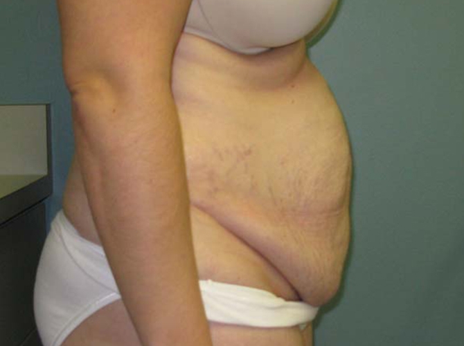 Before treatment: Tummy Tuck and Liposuction Milwaukee, WI Patient's Before and After Photos