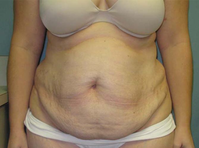 Before treatment: Wisconsin Liposuction and Tummy Tuck Patient Transformation