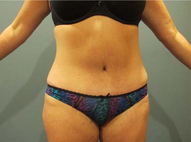 After treatment: Tummy Tuck Milwaukee WI