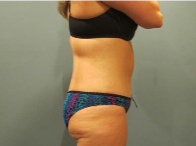 After treatment: Tummy Tuck Milwaukee