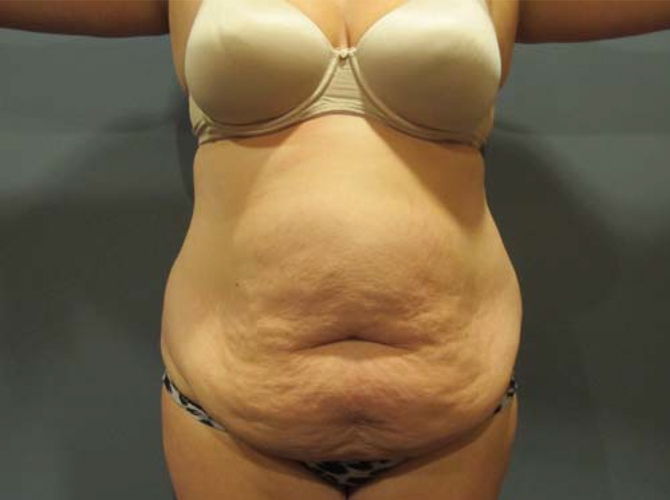 Before treatment: Tummy Tuck Milwaukee WI