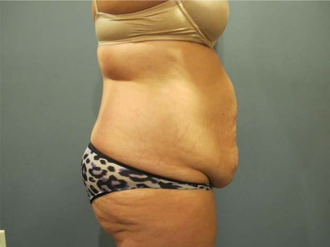 Before treatment: Tummy Tuck Milwaukee