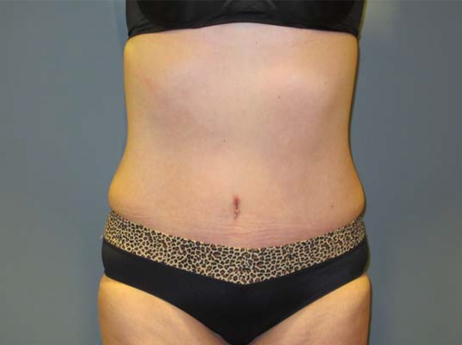 After treatment: Tummy Tuck Madison, WI