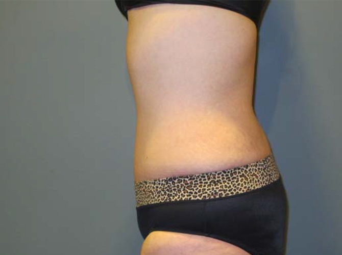 After treatment: Tummy Tuck Oconomowoc, WI