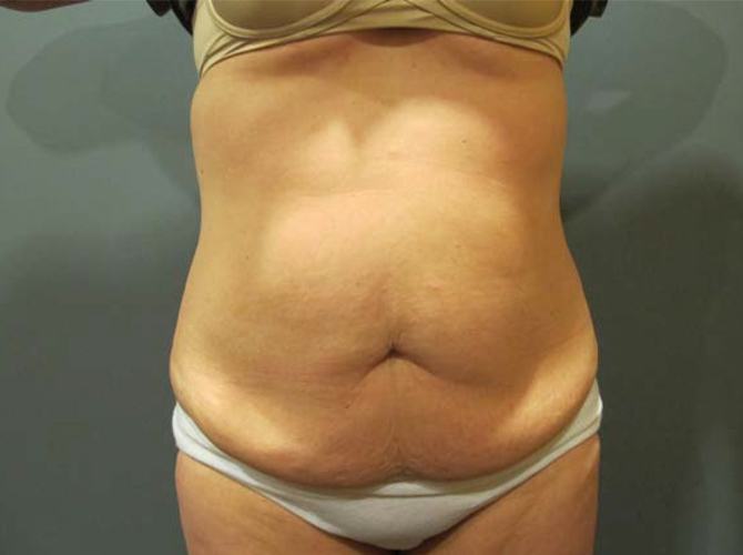 Before treatment: Tummy Tuck Madison, WI