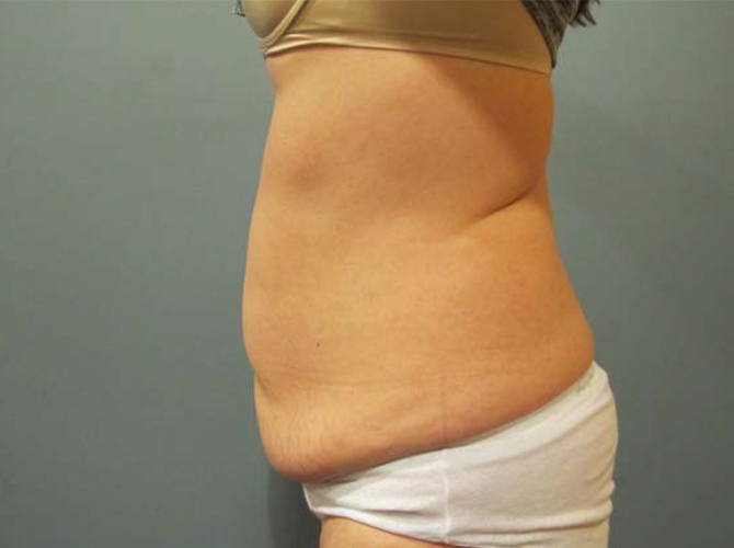 Before treatment: Tummy Tuck Oconomowoc, WI