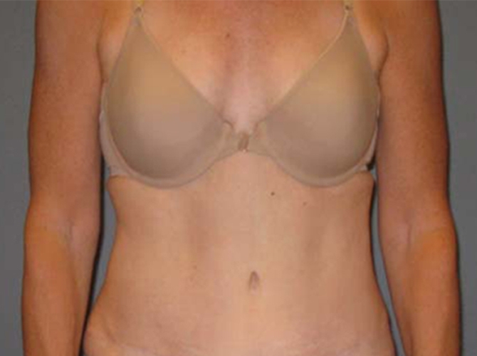 After treatment: The Plastic Surgeon Milwaukee Trusts for Incredible Results