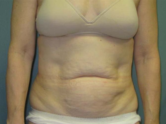 Before treatment: The Plastic Surgeon Milwaukee Trusts for Incredible Results