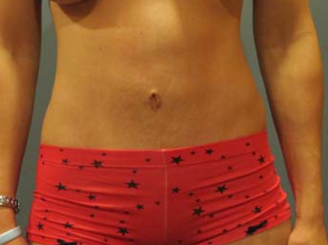 After treatment: Tummy Tuck Delafield, WI