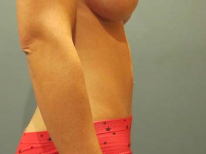 After treatment: Tummy Tuck Waukesha WI Patient Transformation