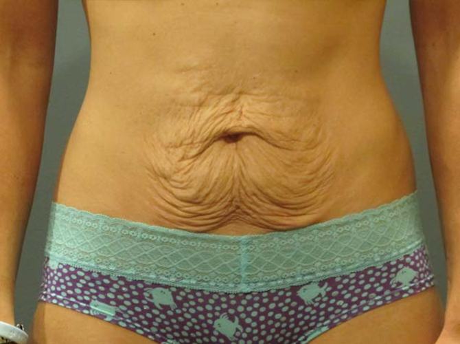 Before treatment: Tummy Tuck Delafield, WI