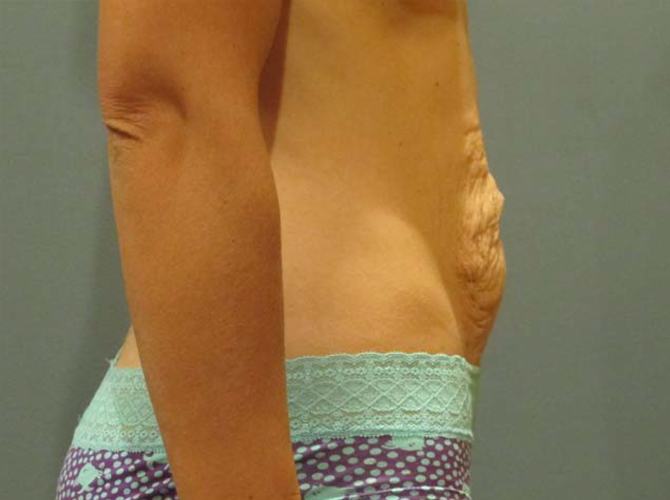 Before treatment: Tummy Tuck Waukesha WI Patient Transformation