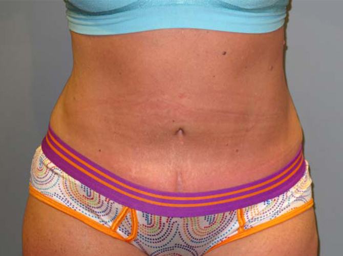 After treatment: Tummy Tuck Waukesha WI
