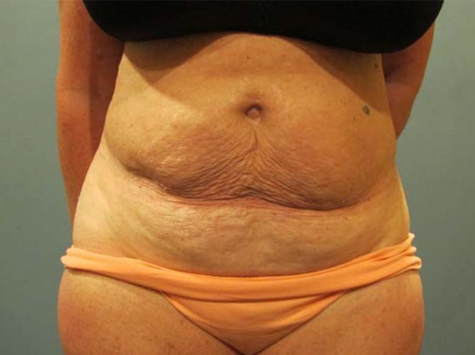 Before treatment: Tummy Tuck Waukesha WI