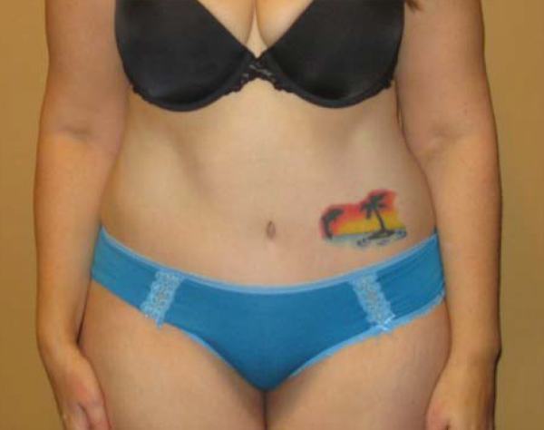 After treatment: Tummy Tuck Brookfield, WI Patient Transformation