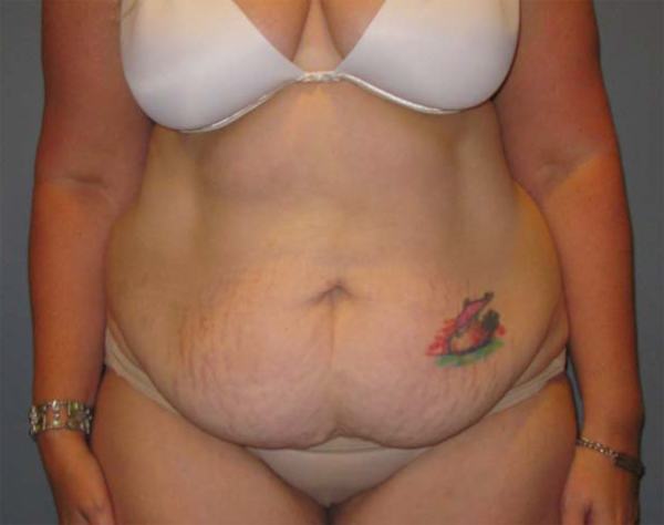 Before treatment: Tummy Tuck Brookfield, WI Patient Transformation