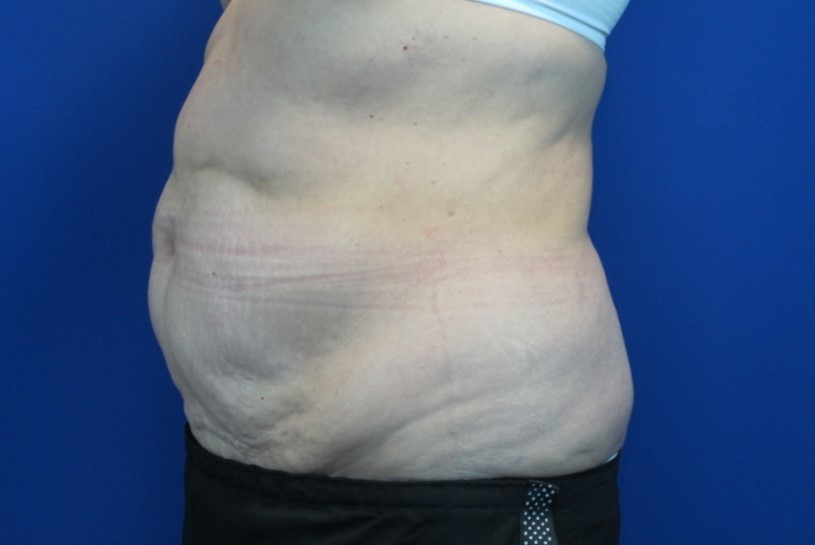 Before treatment: Tummy Tuck Surgery Brookfield