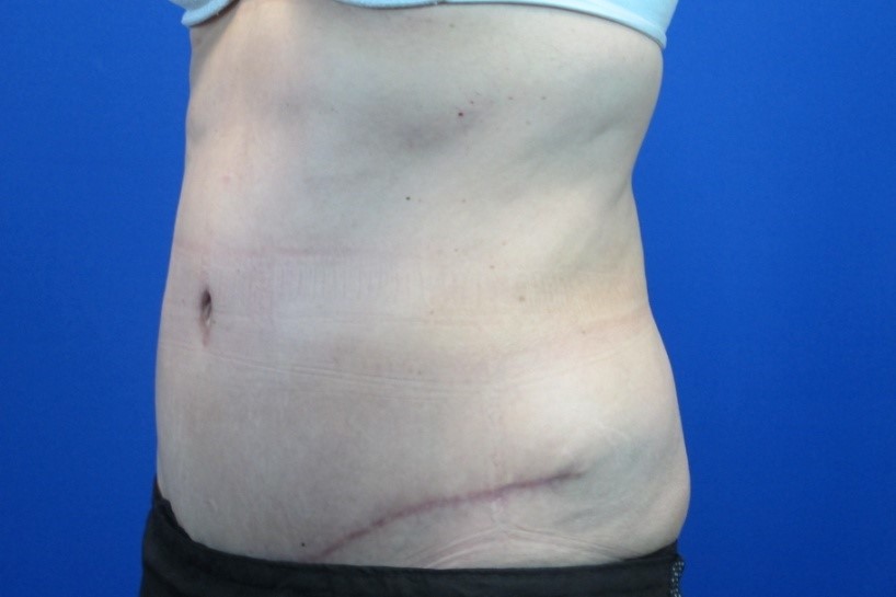 After treatment: Tummy Tuck Surgery Brookfield