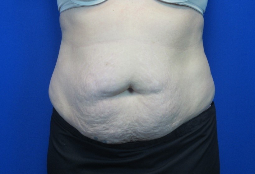 Before treatment: Tummy Tuck Delafield