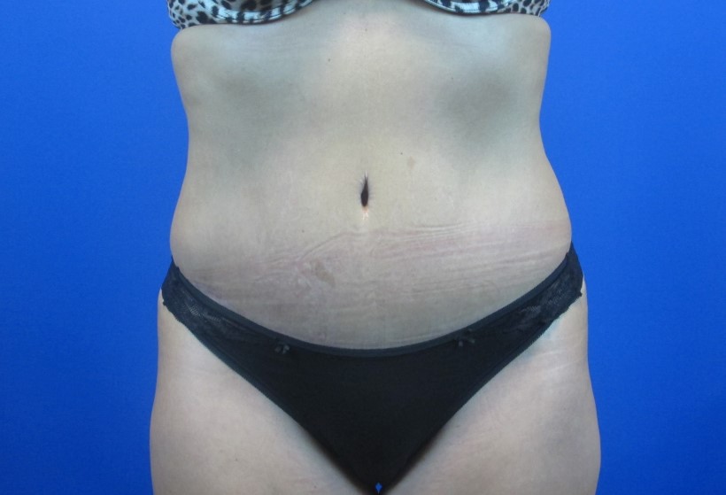 After treatment: Tummy Tuck Delafield
