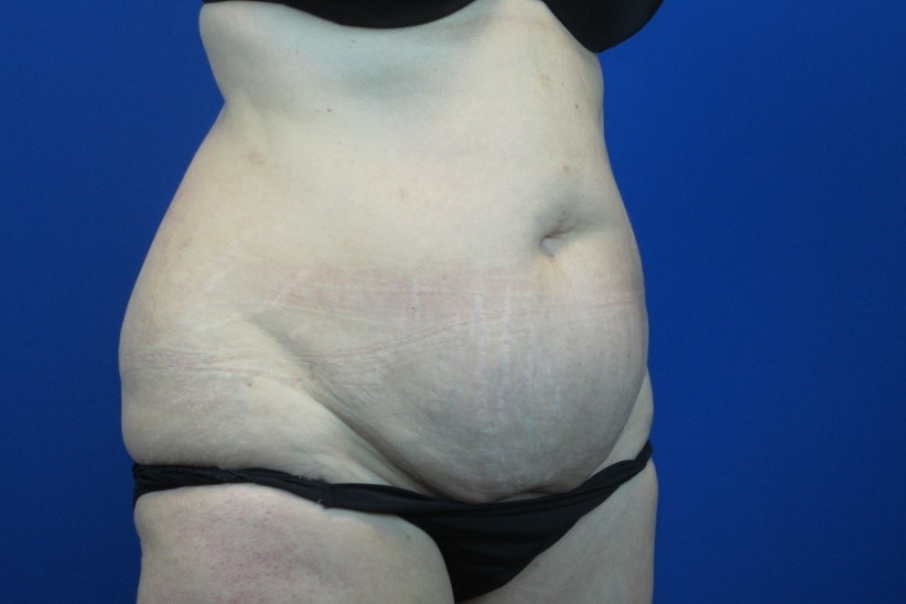 Before treatment: Mequon WI Tummy Tuck Surgery