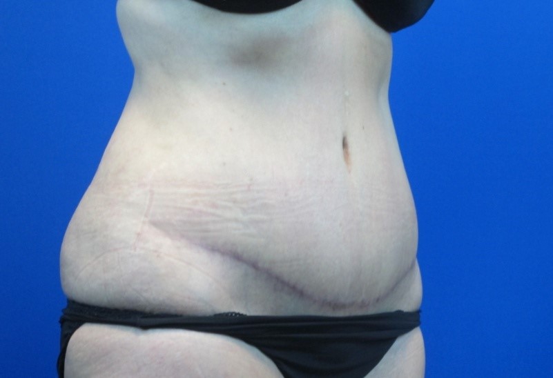 After treatment: Mequon WI Tummy Tuck Surgery