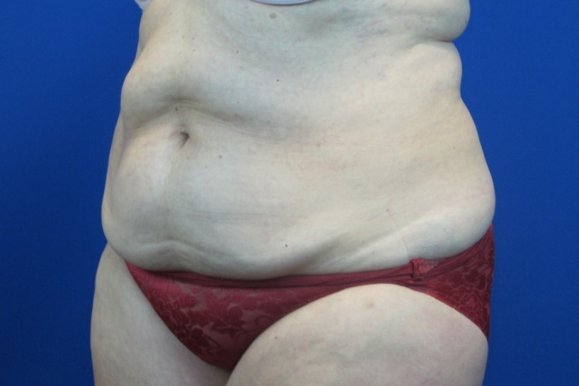 Before treatment: West Bend Tummy Tuck
