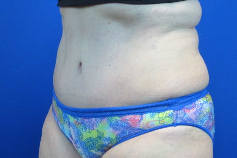 After treatment: West Bend Tummy Tuck