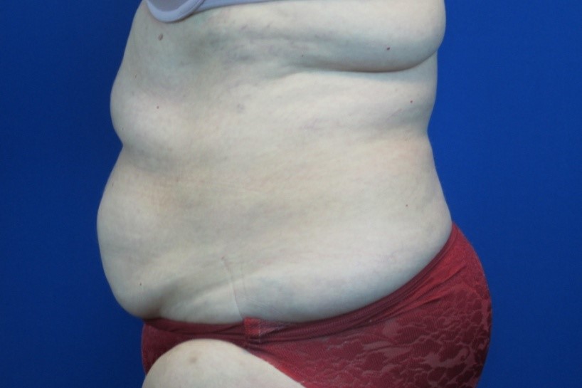 Before treatment: New Berlin Mommy Makeover