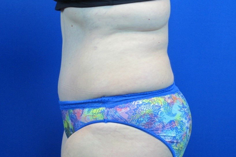 After treatment: New Berlin Mommy Makeover