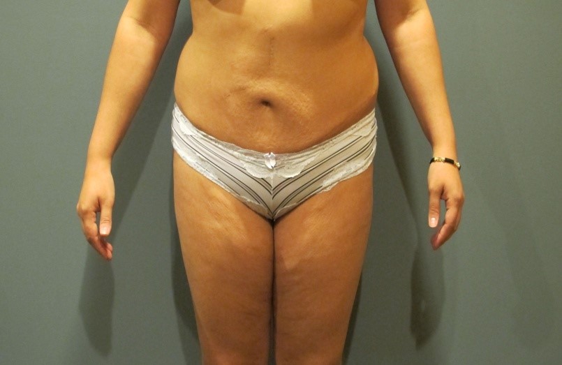 Before treatment: Oconomowoc Tummy Tuck Procedure