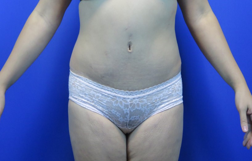 After treatment: Oconomowoc Tummy Tuck Procedure