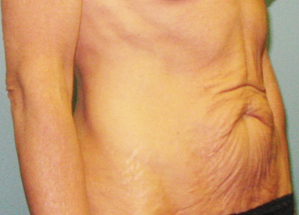 Before treatment: Tummy Tuck Sun Prairie