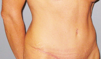 After treatment: Tummy Tuck Sun Prairie