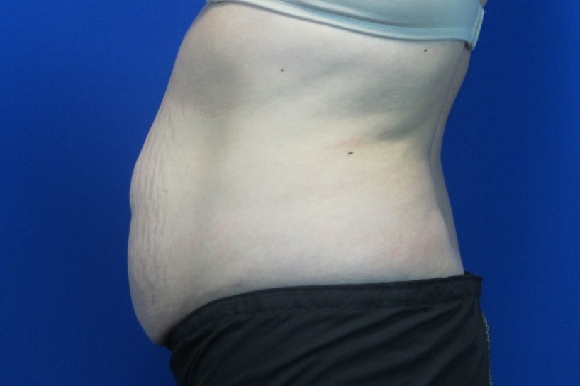 Before treatment: Tummy Tuck Sussex